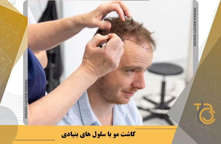 کاشت مو با سلول های بنیادی