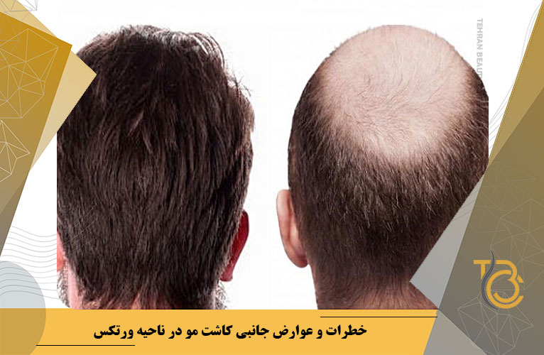 خطرات و عوارض کاشت مو در ناحیه ورتکس