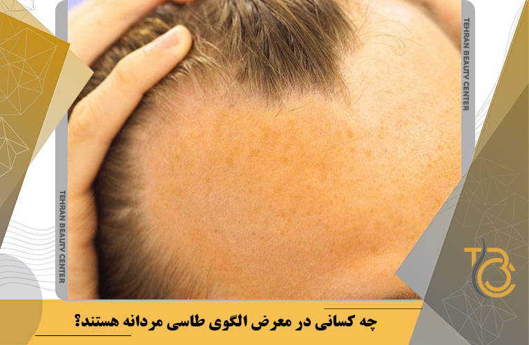 چه کسانی در معرض الگوی طاسی مردانه هستند؟