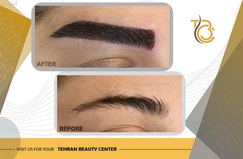 مراقبت های بعد از کاشت ابرو