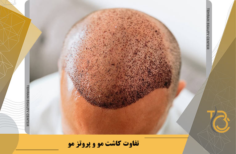 کاشت مو به روش MicroFIT