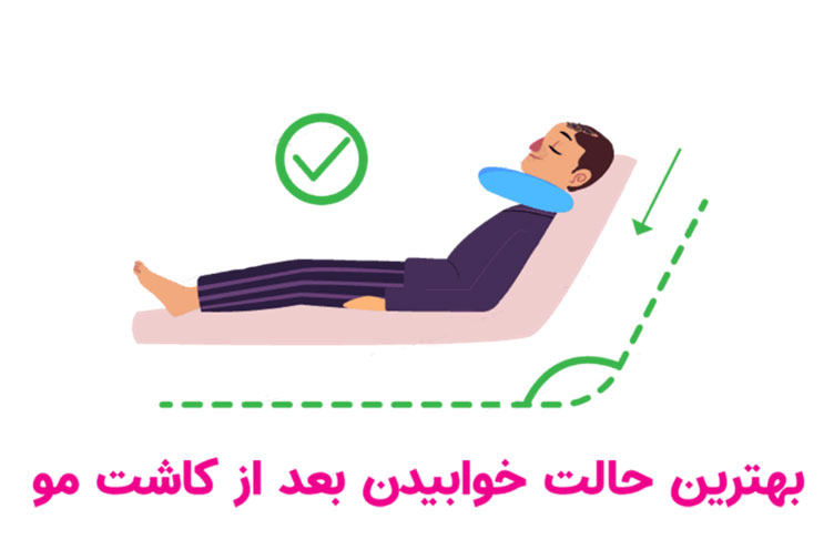 بهترین حالت خوابیدن بعد از کاشت مو