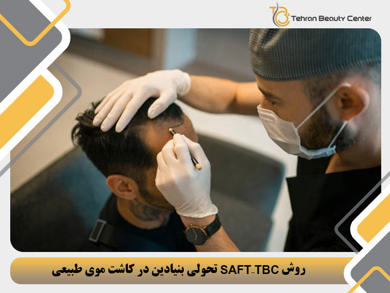 روش SAFT – TBC تحولی بنیادین در کاشت موی طبیعی