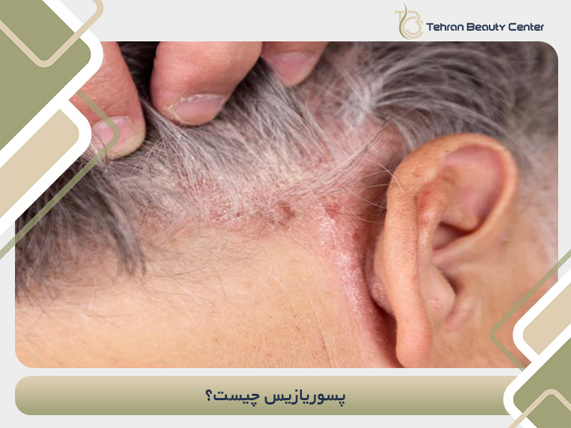 پسوریازیس چیست؟