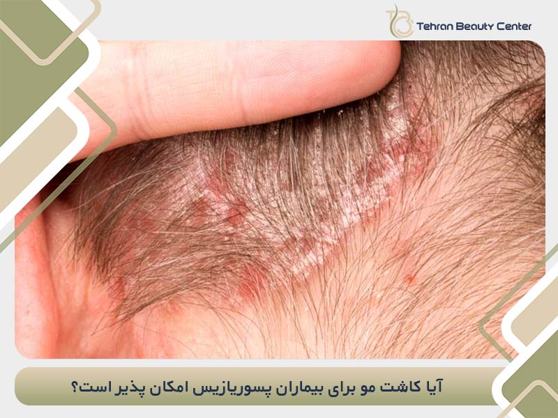 آیا کاشت مو برای بیماران پسوریازیس امکان پذیر است؟