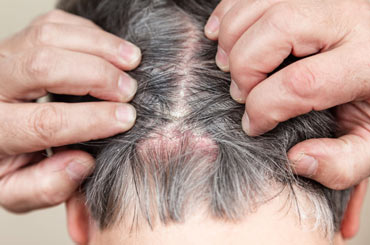 کاشت مو برای بیماران پسوریازیس پوست سر