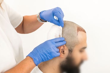 ورم بعد از کاشت مو چیست و چگونه درمان می شود؟