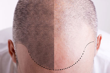 مراحل رشد مو پس از کاشت مو طبیعی