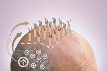10 تصور رایج اشتباه درمورد کاشت مو